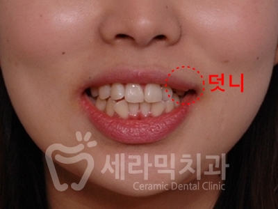 돌출입 덧니 비대칭 치아교정 전후 인상변화! 관련 이미지 2
