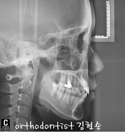 치열 교정 ( 벌어짐 ) 관련 이미지 13