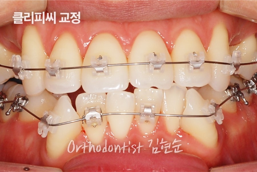 클리피씨교정 기간 짧을까? 관련 이미지 12