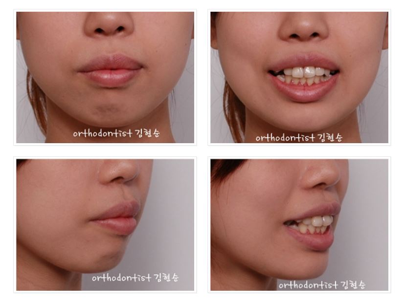 발치교정 부작용 옥니 해결법 관련 이미지 2