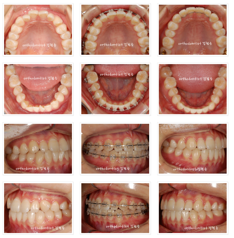 치아의 배열을 개선, 발치하지 않고 교정하기 관련 이미지 6