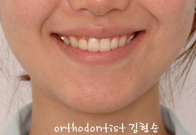 강남 돌출입 교정 관련 이미지 23