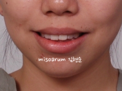 강남치아교정추천 관련 이미지 36