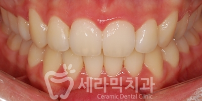 과개교합 치아교정잘하는곳, 세라믹치과 치아교정전후! 관련 이미지 22