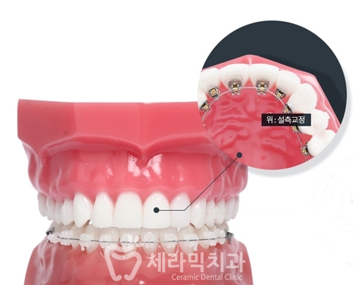 콤비교정 치아교정전후, 남몰래 제대로 교정하기! 관련 이미지 3