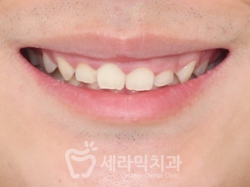과개교합, 거미스마일, 치아 벌어짐까지 한번에! 치아교정전후 살펴보기 관련 이미지 2