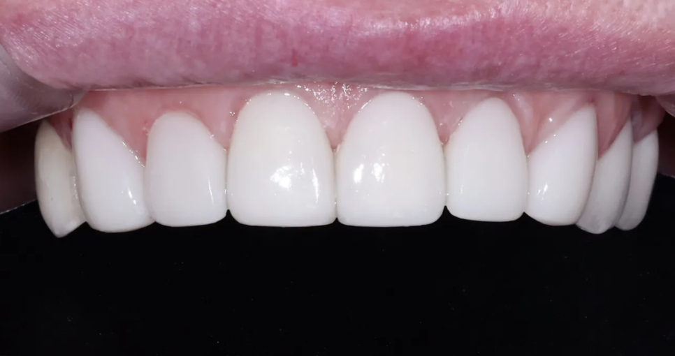 강남구청역 치과, 70대 외국인 환자의 라미네이트 관련 이미지 8