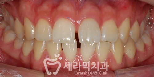 벌어진치아, 앞니벌어짐 치아교정전후 관련 이미지 1