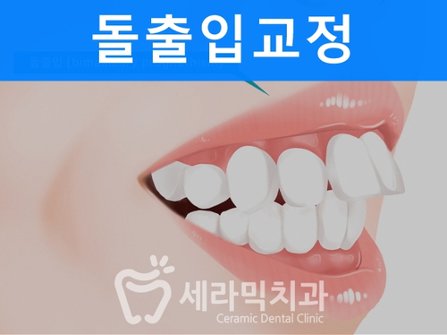 돌출입교정으로 갸름한 턱라인까지 되찾다! 돌출입 치아교정전후 관련 이미지 1