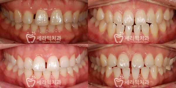 치아교정전후 : 치아사이틈, 벌어진 공간 치아교정으로 치료! 관련 이미지 2