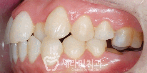 돌출입, 치열불규칙, 치아상실 치아교정과 임플란트 전후 관련 이미지 8
