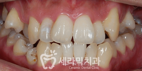 삐뚤빼뚤 틀어지고 불규칙한 치아배열 치아교정전후 관련 이미지 5