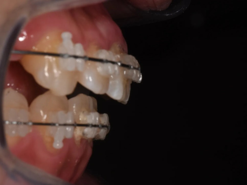 돌출입 교정 전후, 그런데 과개교합까지 있으셨던 환자분 관련 이미지 16