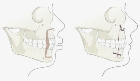 학동역치과 하면 세라믹교정 ~ 관련 이미지 11