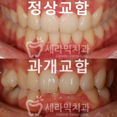 과개교합 치아교정잘하는곳, 세라믹치과 치아교정전후! 관련 이미지 3