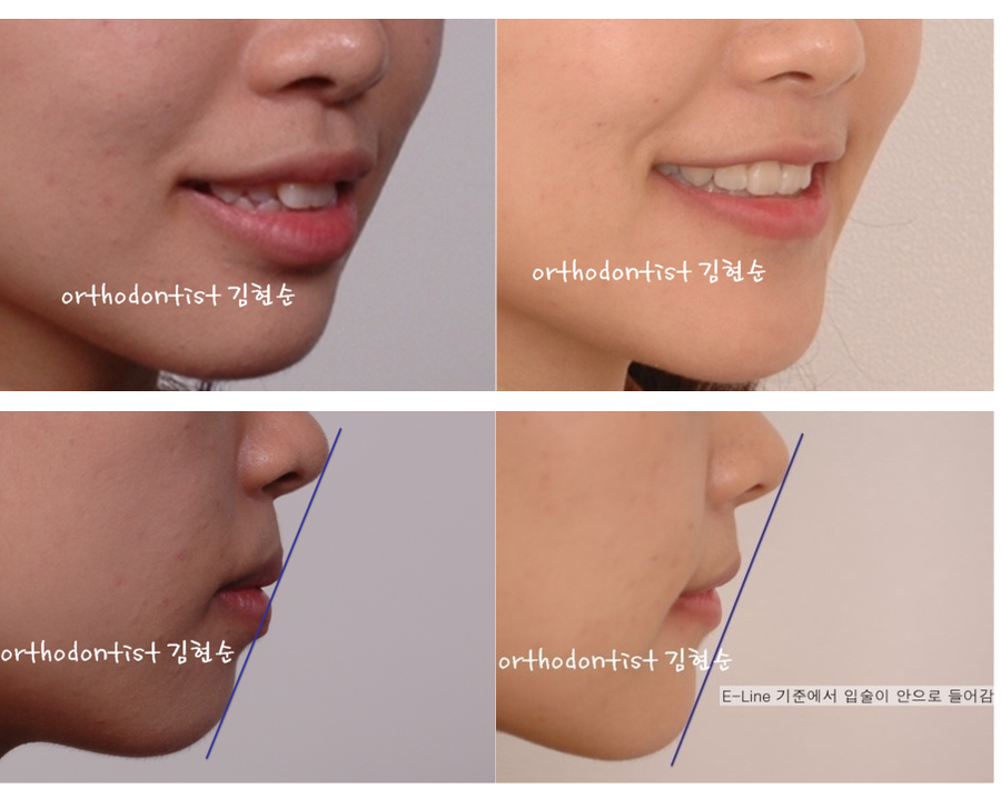 세라믹교정 세라믹치과-돌출입발치교정 4 관련 이미지 7