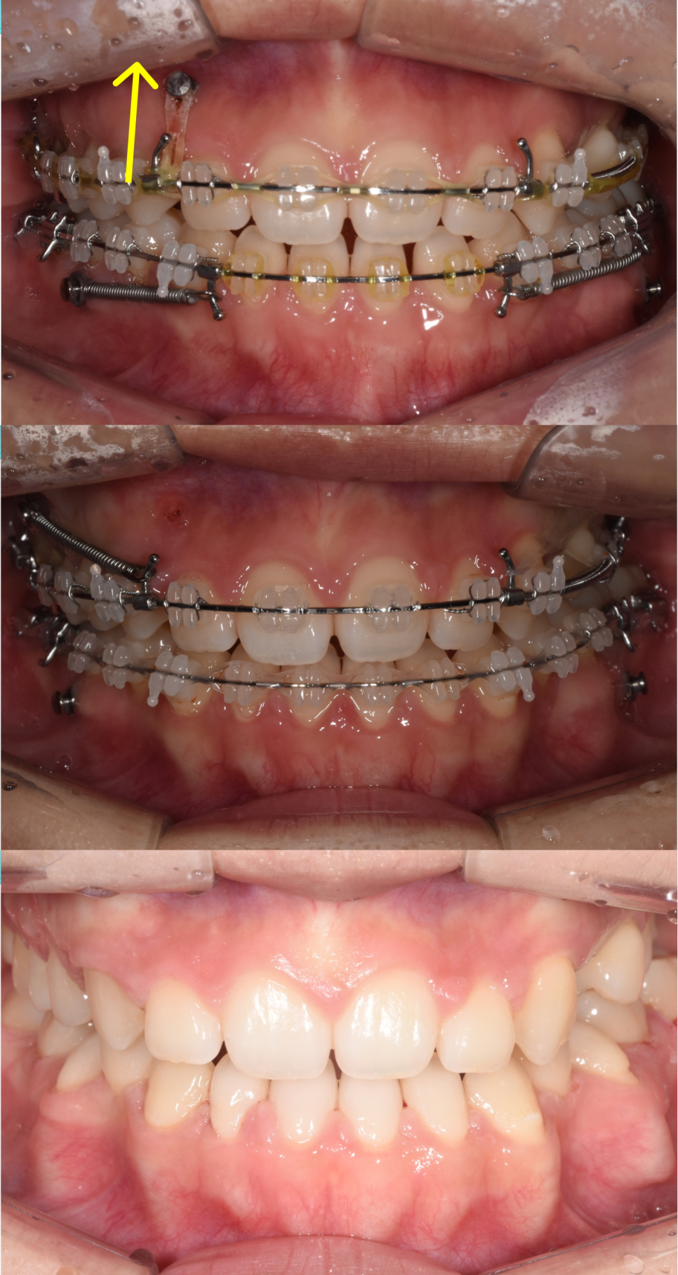 학동역 교정치과, 개방교합과 비대칭을 수술없이 교정한 경우 관련 이미지 10