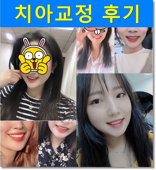 돌출입 투명교정 치아교정전후 관련 이미지 7