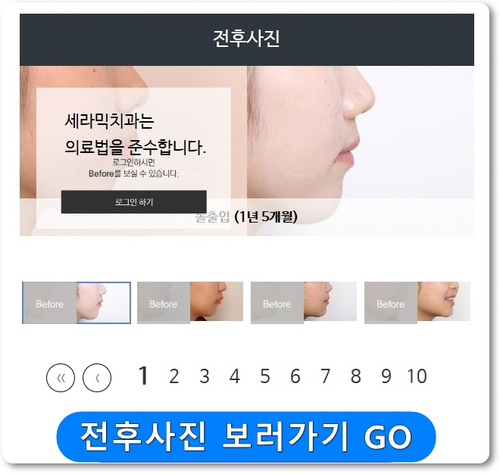 돌출입 세라믹교정으로 자신감 up! 세련미 완성! 관련 이미지 3