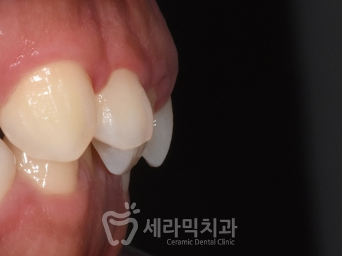A Case of Overretained Teeth and Deep Bite Orthodontics That Helped the Patient Smile Confidently Before and After image 10