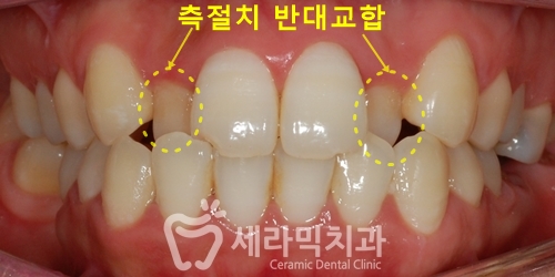 돌출입, 치열불규칙, 치아상실 치아교정과 임플란트 전후 관련 이미지 1