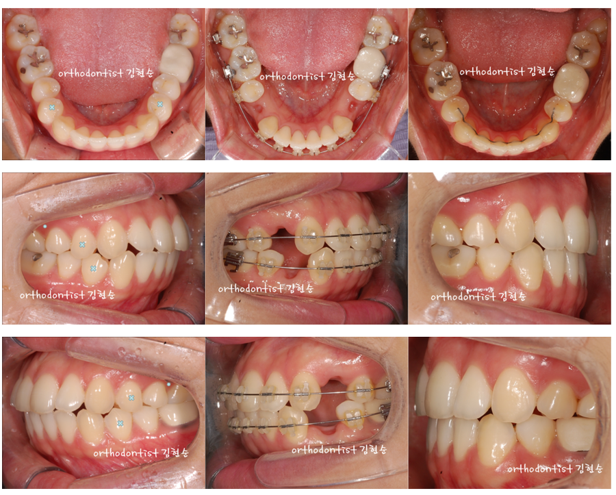세라믹교정 세라믹치과-돌출입발치교정 6 관련 이미지 4