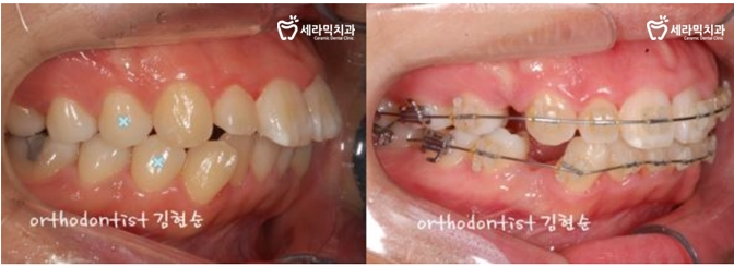 돌출 교정 월15만원 관련 이미지 8