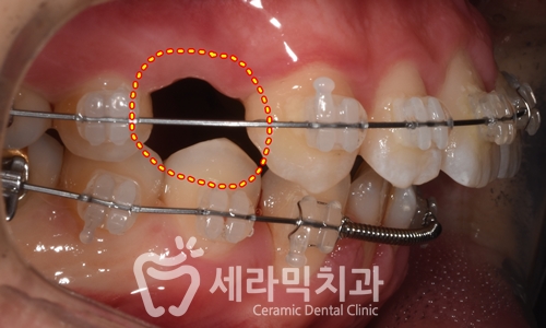 과개교합과 돌출입 개선으로 달라진 인상, 세라믹치과 치아교정전후! 관련 이미지 10