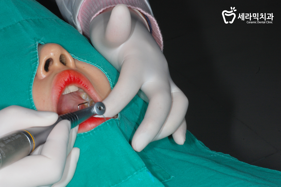 비발치교정 스트리핑이 필요 관련 이미지 4