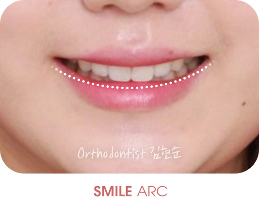 미소모양 치아교정과 스마일아크 관련 이미지 4