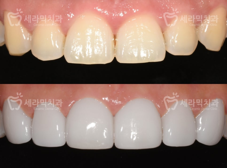 치아교정 VS. 라미네이트. 뭐가 좋은 걸까요? 관련 이미지 5