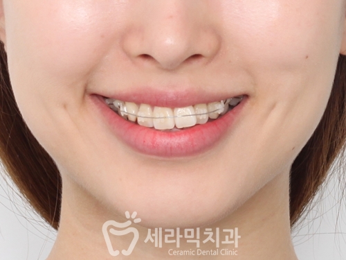 치아교정전후. 돌출입교정으로 갸름한 입술을 얻다! 관련 이미지 3