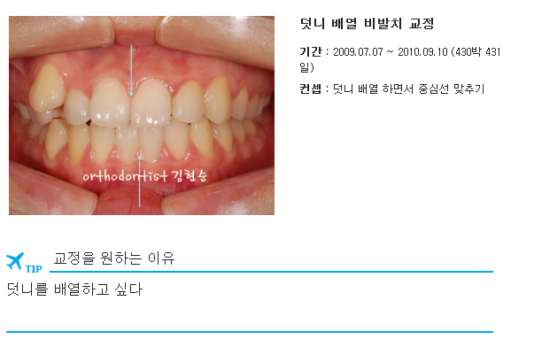 비발치로 덧니의 치열을 개선, 중심선을 맞추는 교정. 관련 이미지 1