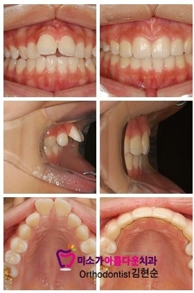 논현동돌출입치아교정 미소가아름다운치과 관련 이미지 1
