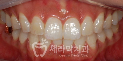 과개교합 치아교정전후, 얼마나 달라졌을까? 관련 이미지 2