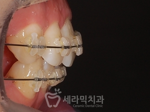 20대 돌출입교정, 무턱교정, 치아교정전후 세련된 얼굴 라인을 되찾다! 관련 이미지 2