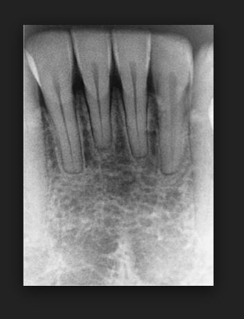 치아교정 부작용 뿌리흡수 관련 이미지 2