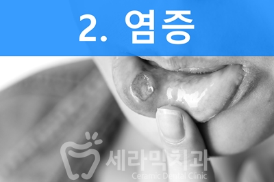 치아교정을 하면 입 냄새가 많이 나요? 관련 이미지 4