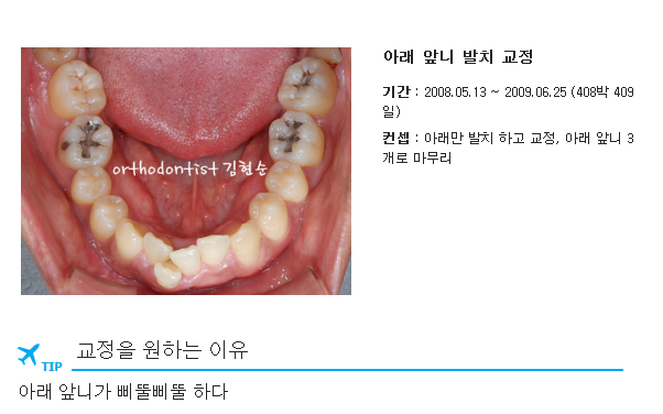들쑥날쑥한 아래 앞니, 발치 후 교정 관련 이미지 1