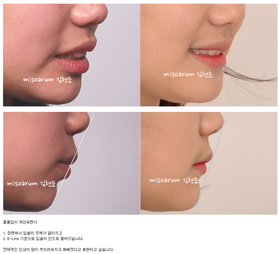 세라믹교정 세라믹치과-돌출입발치교정 9 관련 이미지 7