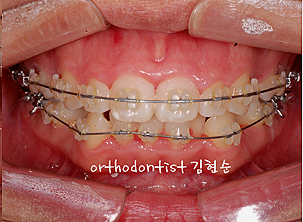 강남 돌출입 교정 관련 이미지 13