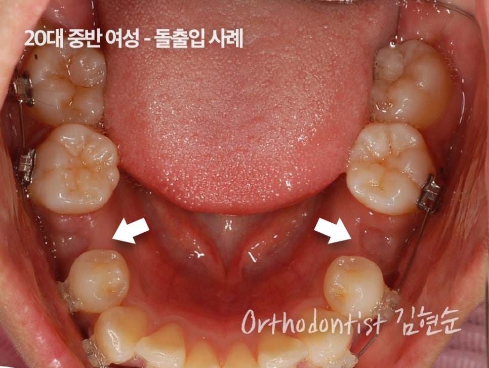 학동역치과 치아교정은 여기서 !! 관련 이미지 10
