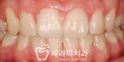 토끼이빨 돌출입 치아교정 전후 표정변화! 관련 이미지 15