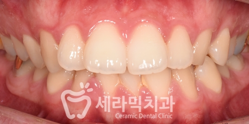 과개교합과 돌출입 개선으로 달라진 인상, 세라믹치과 치아교정전후! 관련 이미지 2