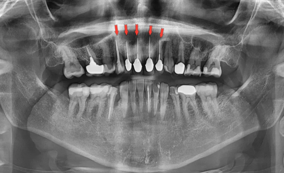 일본에서 거절당했던 앞니 심미보철 크라운 관련 이미지 2