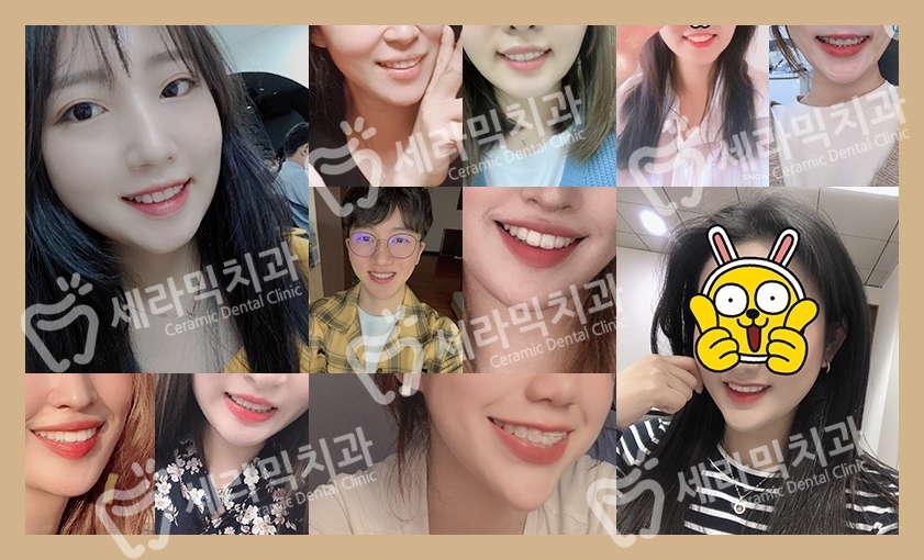 딥바이트(과개교합) 때문에 감추고 싶던 치아, 치아교정전후 달라진 미소 관련 이미지 9