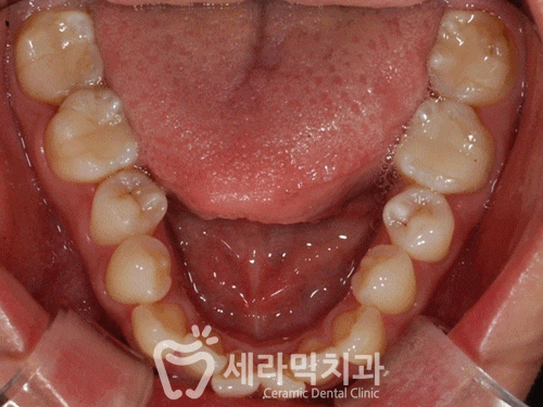 상실된 치아가 있어도, 금니가 있어도 치아교정전후는 계속된다! 관련 이미지 9