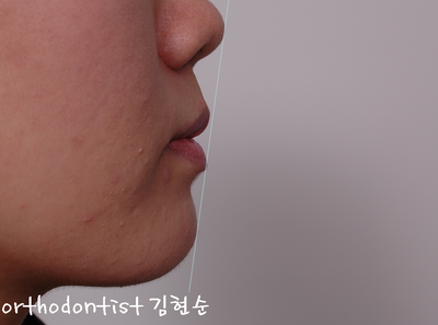 치열 교정 ( 벌어짐 ) 관련 이미지 11