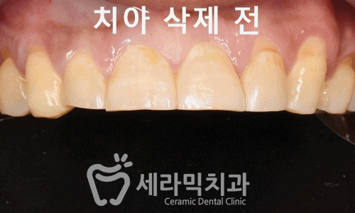 치아교정과 라미네이트는 선택이 아닌 상호 보완관계! 관련 이미지 9
