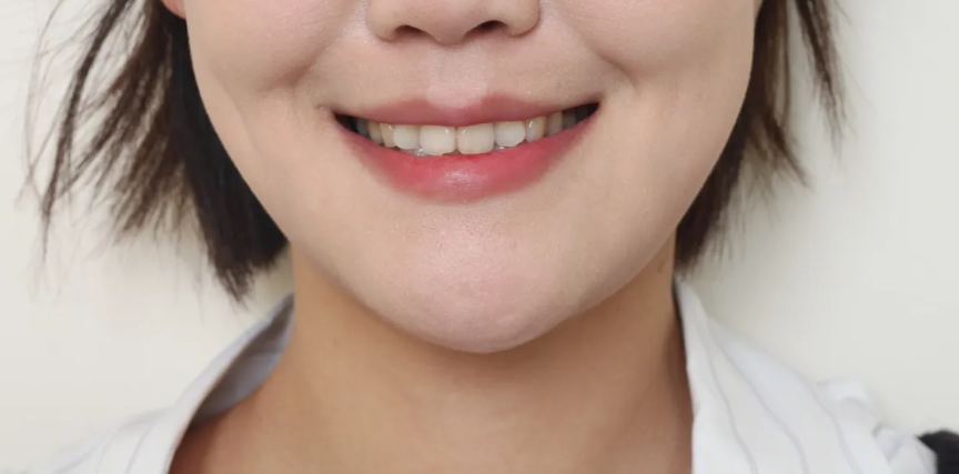 앞니 삐뚤어짐, 교정 없이 라미네이트로 해결한 경우 관련 이미지 2